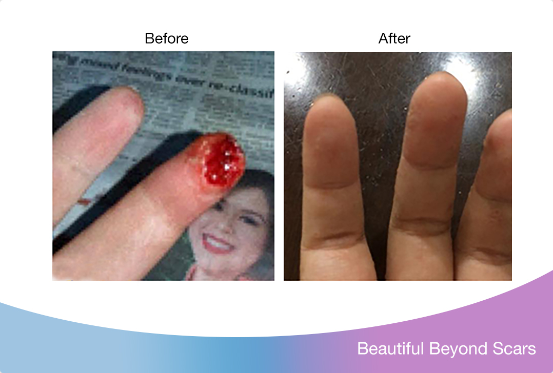 my scars became softer and flatter