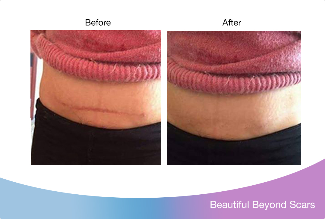 my scar is now virtually impossible