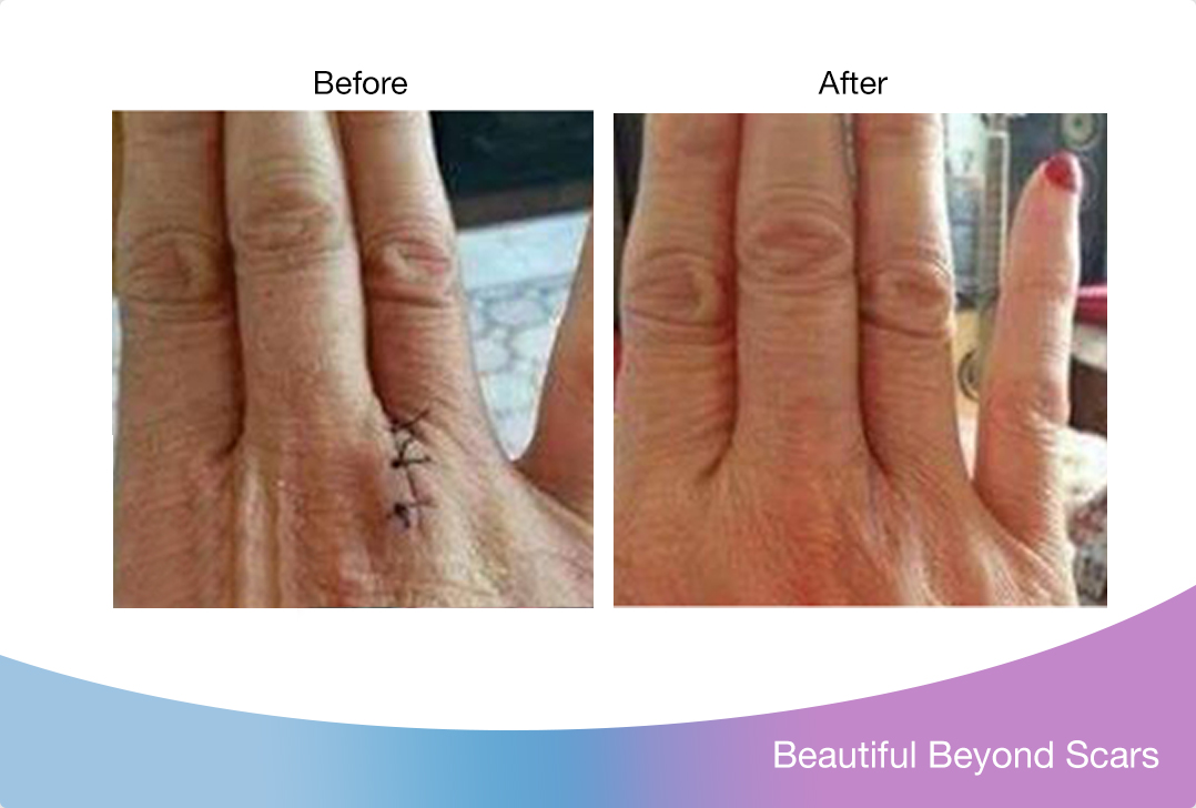 my scar is barely noticeable